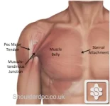 pectoralis major tendon strain pic 2.webp